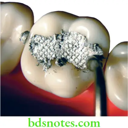 Dental Materials Dental Amalgam Amalgam condensation