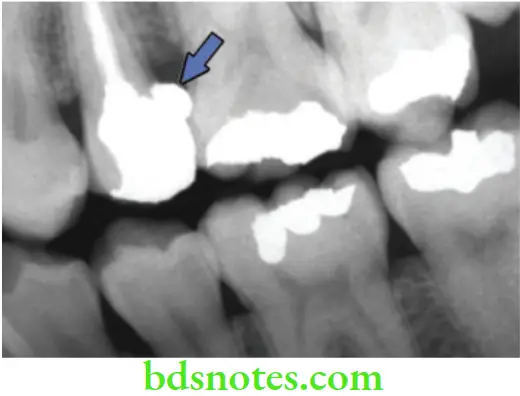Dental Materials Dental Amalgam Amalgam overhang resulting from failure to use matrix effectively