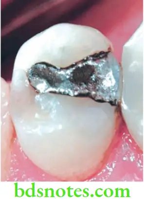 Dental Materials Dental Amalgam Amalgam with high creep rate displaying marginal breakdown