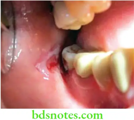 Dental Materials Dental Amalgam Lichenoid reaction on mucosa adjacent to amalgam restoration