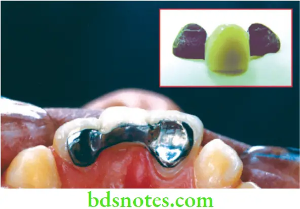 Dental Materials Dental Cements An etched resin bonded cast restoration