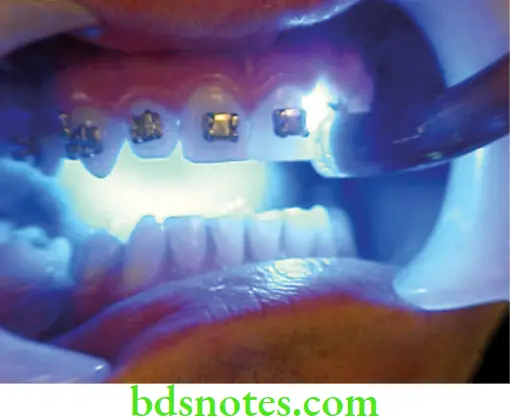 Dental Materials Dental Cements Bonding of orthodontic brackets
