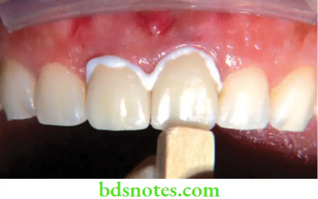 Dental Materials Dental Cements Luting procedure of 2 all ceramic anterior crowns