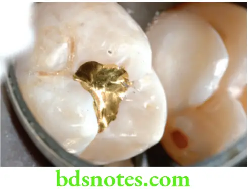 Dental Materials Direct Filling Gold Class 1 gold restoration