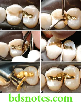 Dental Materials Direct Filling Gold Some of the steps in the placement of a direct filling gold restoration