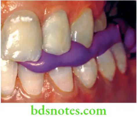 Dental Materials Elastomeric Impression Materials Bite registration procedure using bite registration silicone