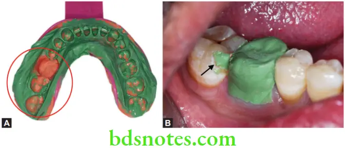 Dental Materials Elastomeric Impression Materials Impression error caused by oxygen inhibited layer