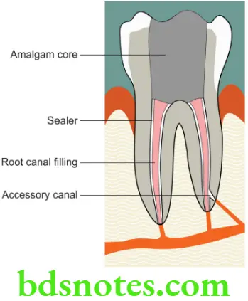 Dental Materials Endodontic Medicaments and Irrigants A root canal treated tooth