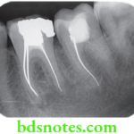 Dental Materials Endodontic Sealers and Obturating Materials Root canal obturated with silver point