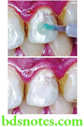 Dental Materials Resin based Composites and Bonding Agents Frosted appearance after a 15 second etch with 37% phosphoric acid