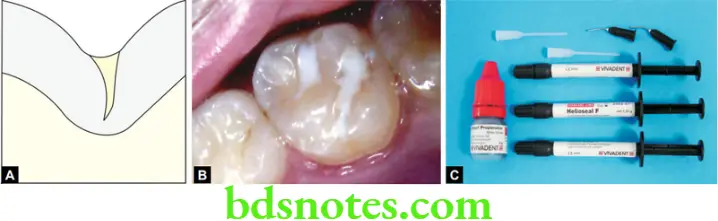 Dental Materials Resin based Composites and Bonding Agents Pit and fissure sealants