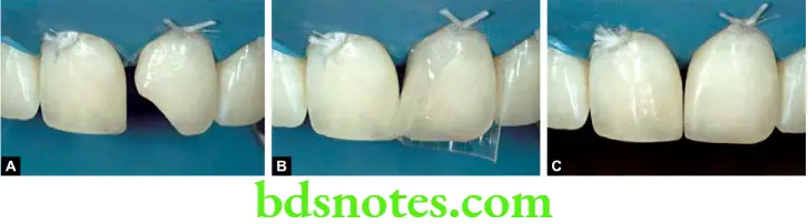 Dental Materials Resin based Composites and Bonding Agents Rubber dam isolation is critical