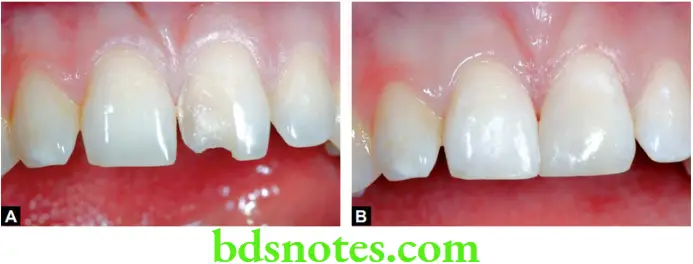 Dental Materials Resin based Composites and Bonding Agents The Illustrations show a fractured central incisor