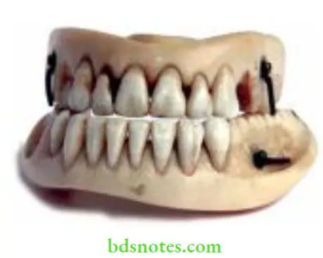 Denture Resins And Polymers Ivory dentures inlaid with natural human teeth.