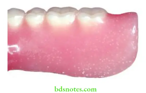 Denture Resins And Polymers Surface and subsurface porosity from lack of insuffiient pressure during curing.