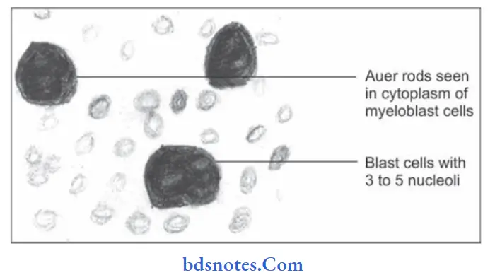 Diseases of blood and blood forming organs Acute myeloid leukemia