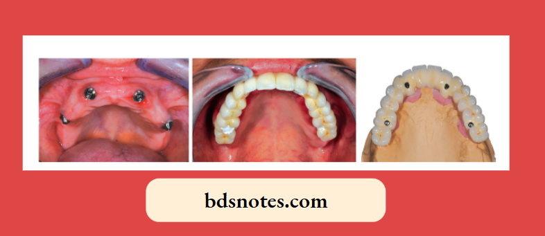 Four titanium screw implants in the maxillary edentulous jaw