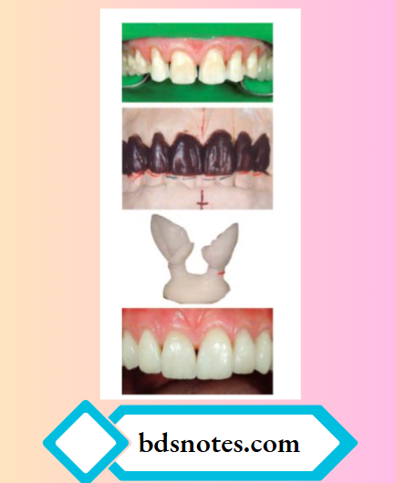 IPS empress. Teeth prepared for veneer,Wax patterns Pressed