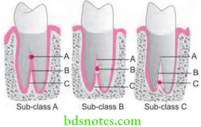 Periodontics Furcation Involvement And Its Management Classification by Tarrow and Fletcher