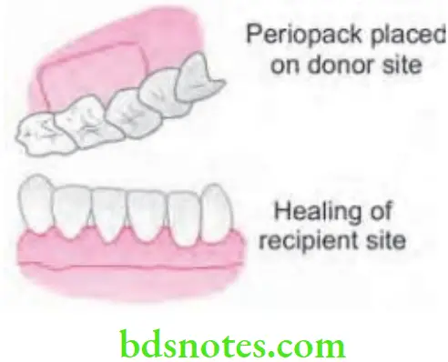 Periodontics Mucogingival Surgery Periodontal Plastic Surgery Step 5 Protection of the donor site