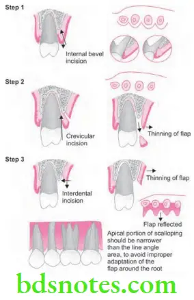Periodontics Periodontal Flap Apically displaced flap surgery