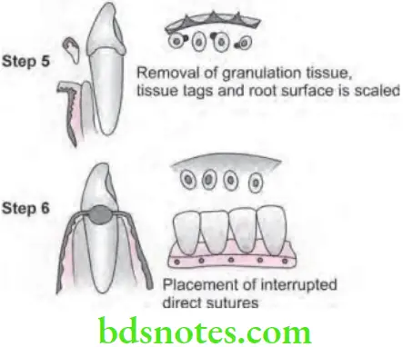 Periodontics Periodontal Flap Modified Widman flap various steps 3