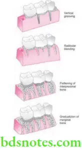 Resective Osseous Surgery In Periodontal Question And Answers - BDS Notes