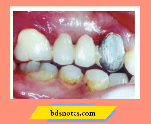 Porcelain Metal Bond