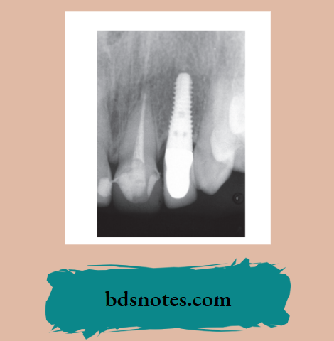 Radiograph showing an endosteal implant.
