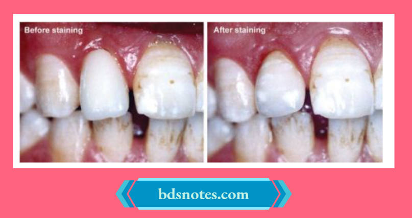 Staining Improves The Vitality Of The Crown