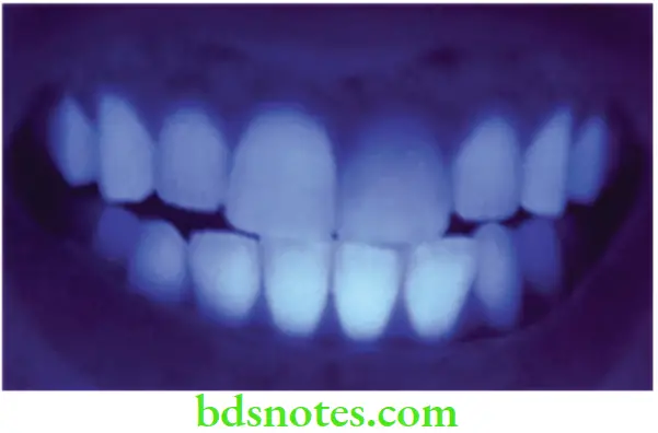 Structure and Properties Dental Materials Aritificial crown on left central appears dark under UV light because of insufficient fluorescence