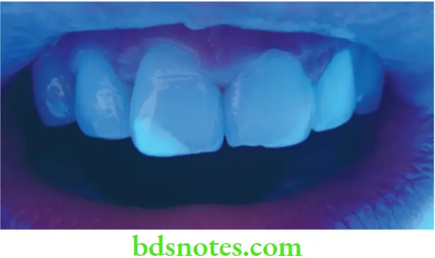 Structure and Properties Dental Materials Composite restoration showing greater fluorescence