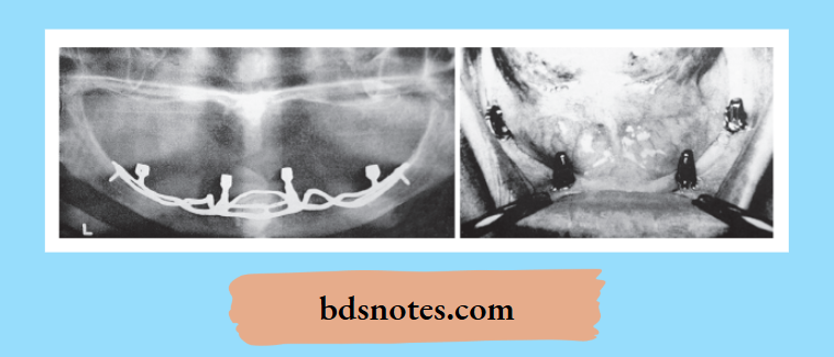 Subperiosteal implant radiograph Intraoral view