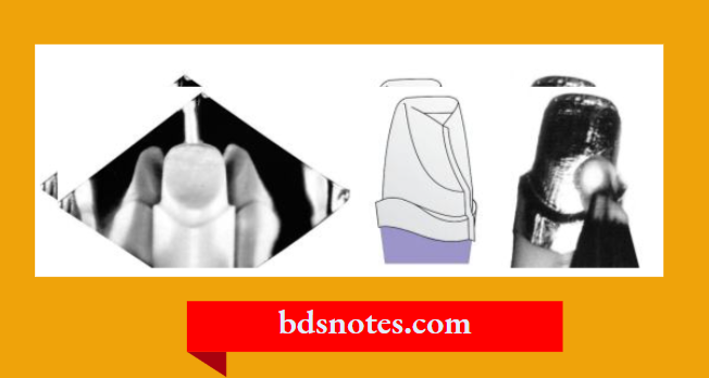 The porcelain jacket crown with aluminous core.