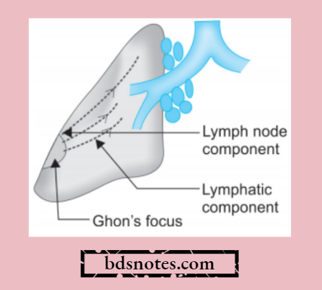 Tuberculous Granuloma In Lungs