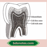 Attached Pulp Stones To Dentin