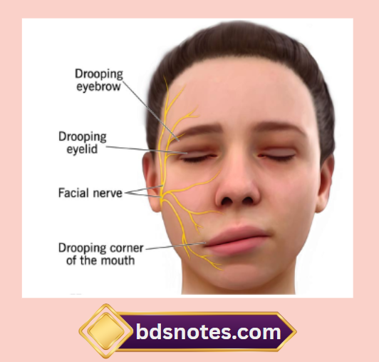 Bell's Palsy Affected Nerve