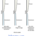 Cementum-types-of-cementoenamel-junction