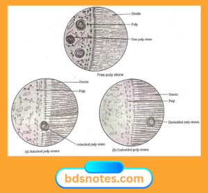 Embedded Pulp Stone Understanding Pulp Stones: A Complete Guide for Dental Students - BDS Notes