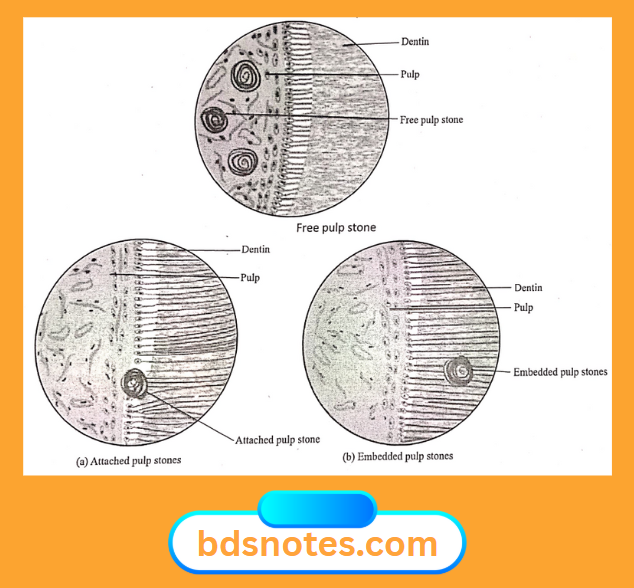 Free Attached Embedded Pulp Stones