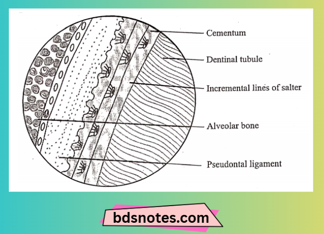 Hypercementosis Diagram