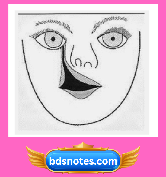 Oblique Facial Cleft Illustration