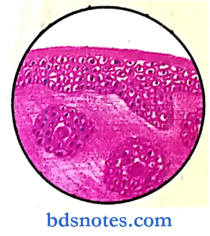 Oral Pathology Slides capillary squamous cell carcinoma