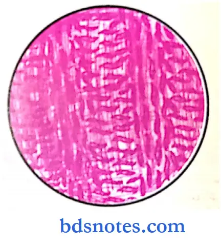 Oral Pathology Slides fibrosarcoma