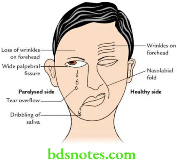 Head And Neck Cranial nerves Bell palsy