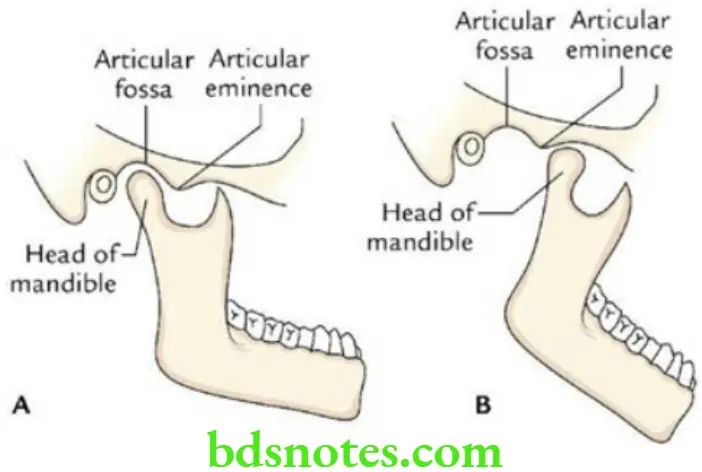 Head And Neck Infratemporal fossa temporomandibular joint and pterygopalatine fossa Dislocation of TMJ