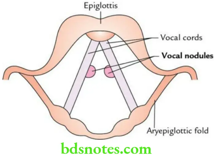 Head And Neck Larynx Vocal nodules
