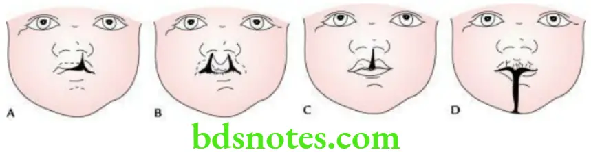 Head And Neck Scalp temple and face Types of cleft lip