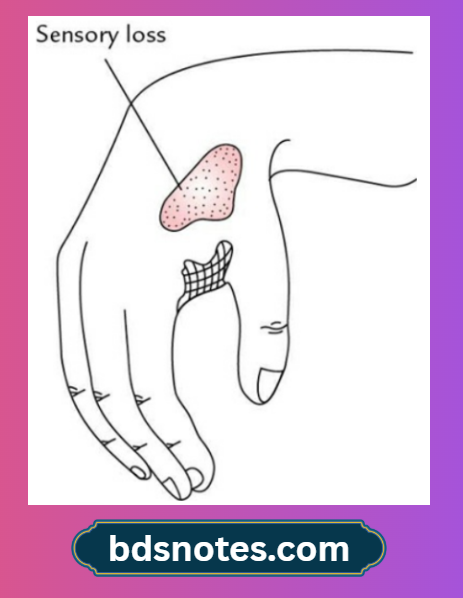 Radial Nerve Palsy Wrist Drop Classic Sign