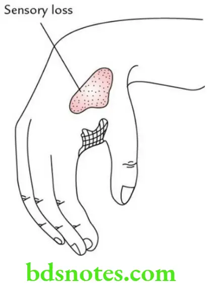 Upper Limb Nerves of the upper limb Wrist drop resulting from radial nerve injury